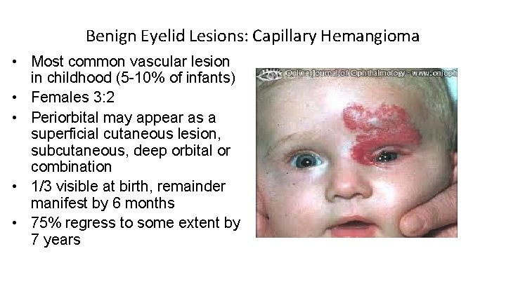 Benign Eyelid Lesions: Capillary Hemangioma • Most common vascular lesion in childhood (5 -10%