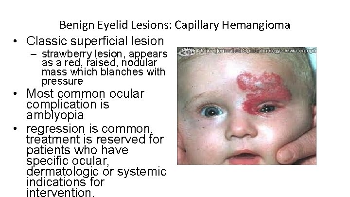 Benign Eyelid Lesions: Capillary Hemangioma • Classic superficial lesion – strawberry lesion, appears as