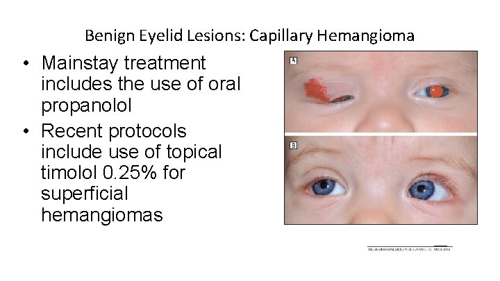 Benign Eyelid Lesions: Capillary Hemangioma • Mainstay treatment includes the use of oral propanolol