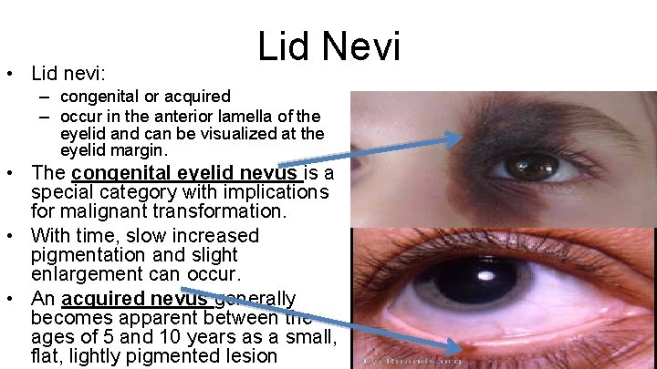  • Lid nevi: Lid Nevi – congenital or acquired – occur in the