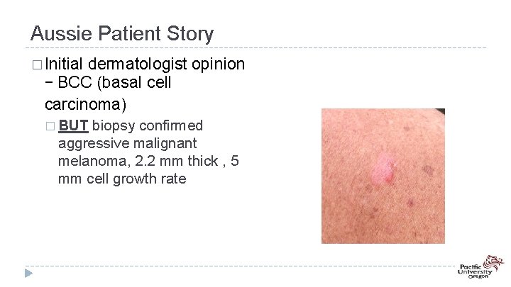 Aussie Patient Story � Initial dermatologist opinion – BCC (basal cell carcinoma) � BUT