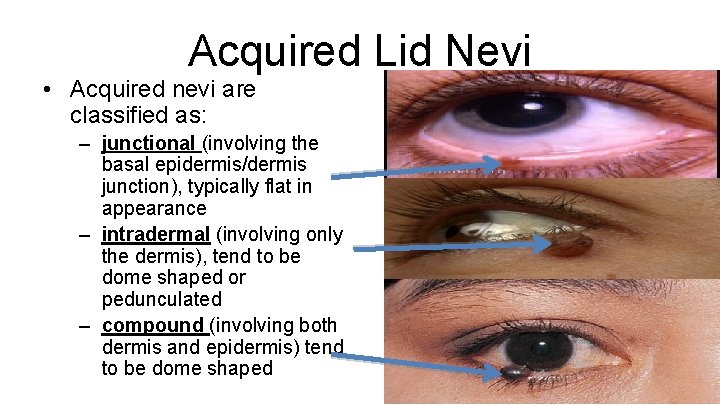 Acquired Lid Nevi • Acquired nevi are classified as: – junctional (involving the basal