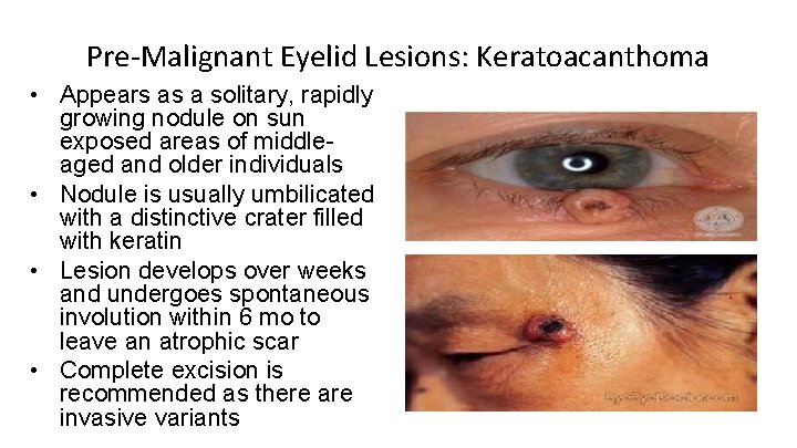 Pre-Malignant Eyelid Lesions: Keratoacanthoma • Appears as a solitary, rapidly growing nodule on sun