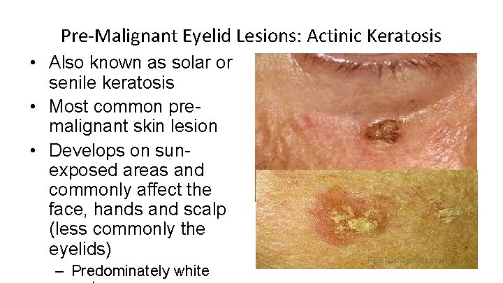 Pre-Malignant Eyelid Lesions: Actinic Keratosis • Also known as solar or senile keratosis •