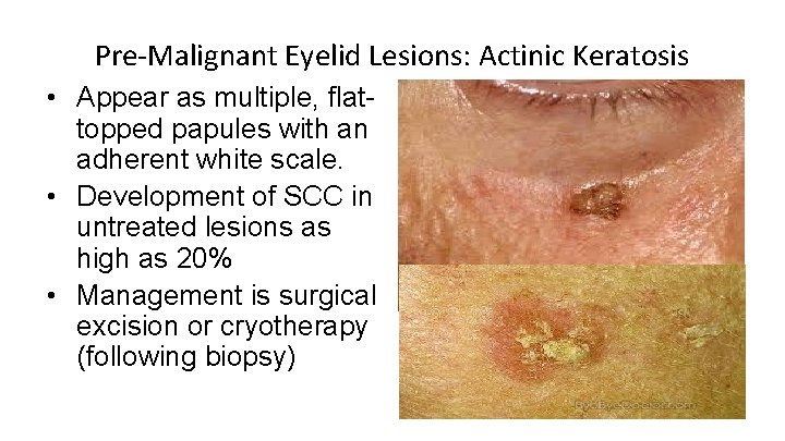 Pre-Malignant Eyelid Lesions: Actinic Keratosis • Appear as multiple, flattopped papules with an adherent