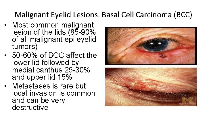 Malignant Eyelid Lesions: Basal Cell Carcinoma (BCC) • Most common malignant lesion of the