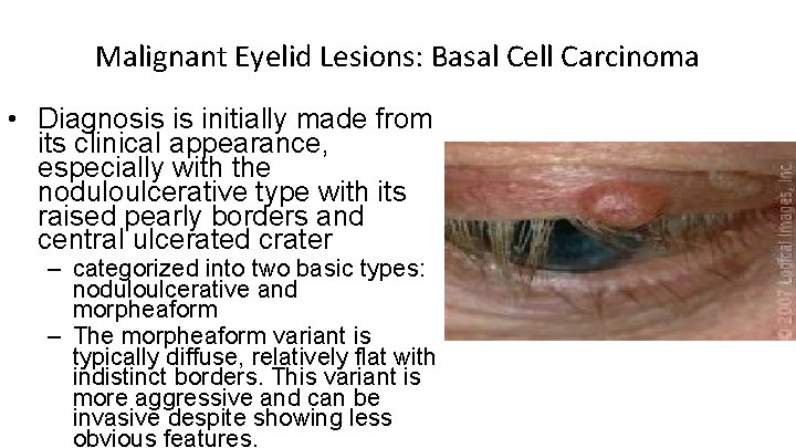 Malignant Eyelid Lesions: Basal Cell Carcinoma • Diagnosis is initially made from its clinical