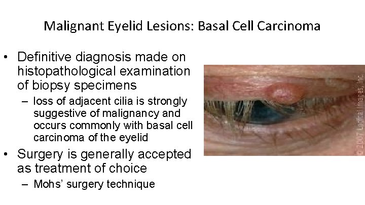 Malignant Eyelid Lesions: Basal Cell Carcinoma • Definitive diagnosis made on histopathological examination of