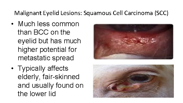 Malignant Eyelid Lesions: Squamous Cell Carcinoma (SCC) • Much less common than BCC on