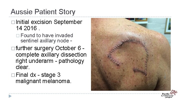 Aussie Patient Story � Initial excision September 14 2016. � Found to have invaded