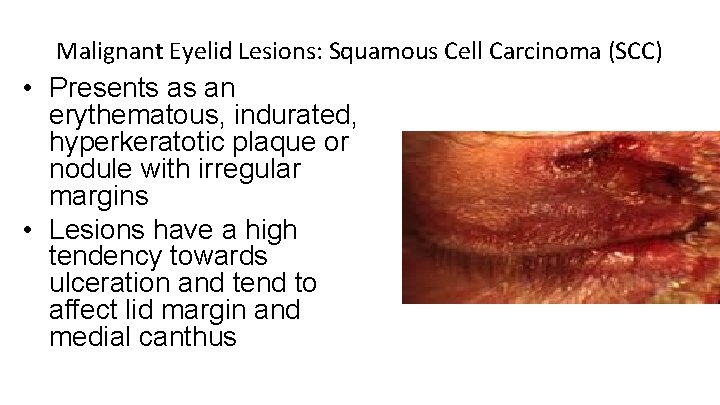 Malignant Eyelid Lesions: Squamous Cell Carcinoma (SCC) • Presents as an erythematous, indurated, hyperkeratotic