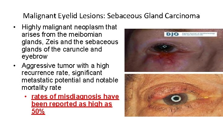 Malignant Eyelid Lesions: Sebaceous Gland Carcinoma • Highly malignant neoplasm that arises from the