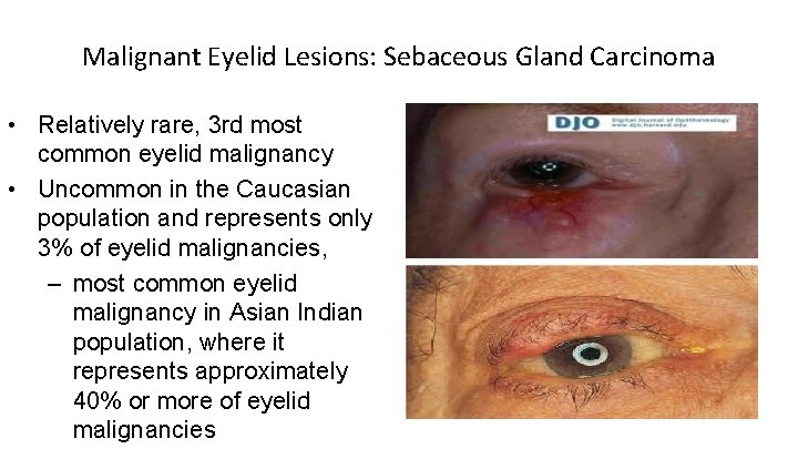 Malignant Eyelid Lesions: Sebaceous Gland Carcinoma • Relatively rare, 3 rd most common eyelid