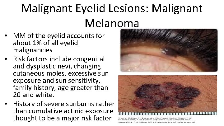 Malignant Eyelid Lesions: Malignant Melanoma • MM of the eyelid accounts for about 1%