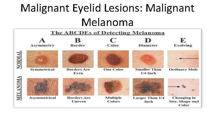 Malignant Eyelid Lesions: Malignant Melanoma 