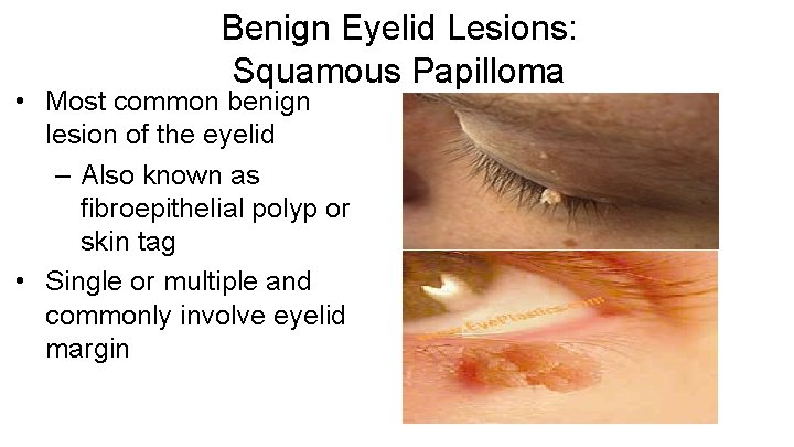 Benign Eyelid Lesions: Squamous Papilloma • Most common benign lesion of the eyelid –