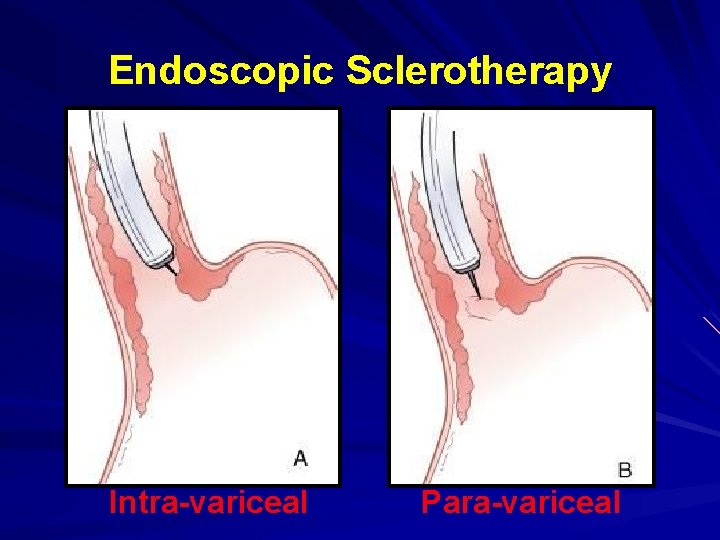 Endoscopic Sclerotherapy Intra-variceal Para-variceal 