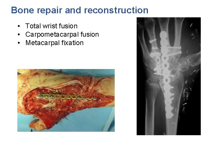 Bone repair and reconstruction • Total wrist fusion • Carpometacarpal fusion • Metacarpal fixation
