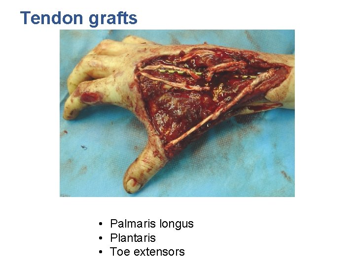 Tendon grafts • Palmaris longus • Plantaris • Toe extensors 