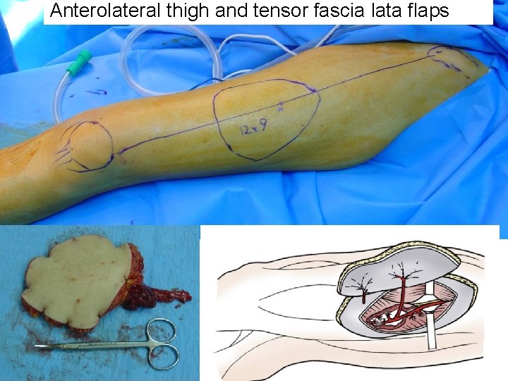 Anterolateral thigh and tensor fascia lata flaps 