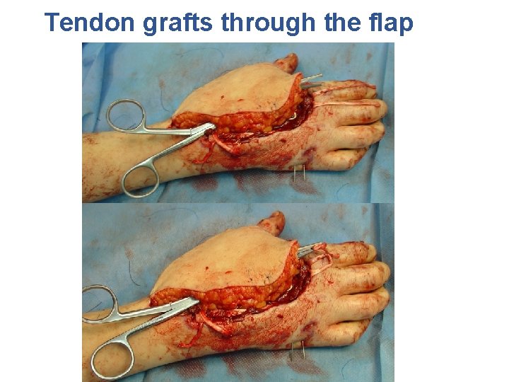 Tendon grafts through the flap 