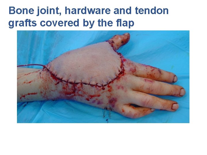 Bone joint, hardware and tendon grafts covered by the flap 
