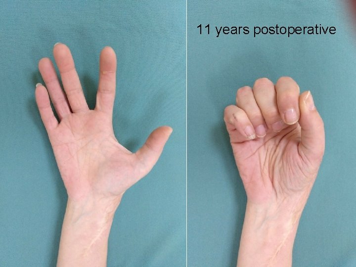 11 years postoperative 