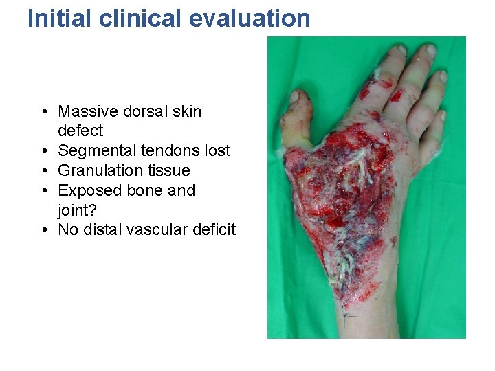 Initial clinical evaluation • Massive dorsal skin defect • Segmental tendons lost • Granulation