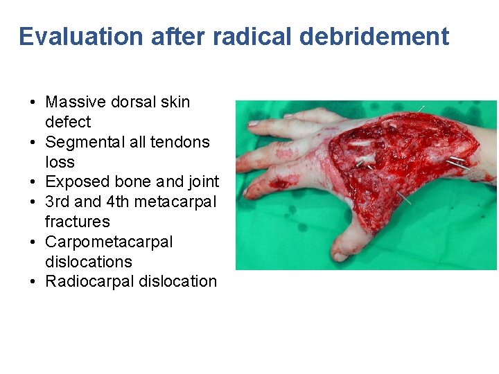 Evaluation after radical debridement • Massive dorsal skin defect • Segmental all tendons loss