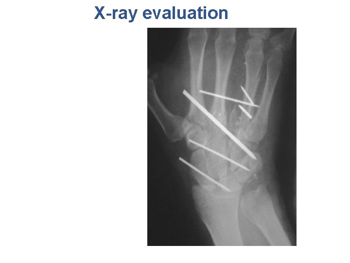 X-ray evaluation 