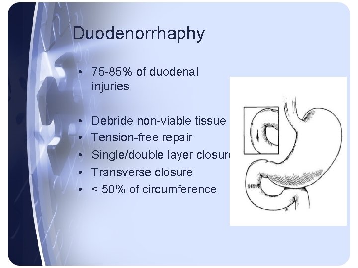 Duodenorrhaphy • 75 -85% of duodenal injuries • • • Debride non-viable tissue Tension-free Duodenorrhaphy • 75 -85% of duodenal injuries • • • Debride non-viable tissue Tension-free