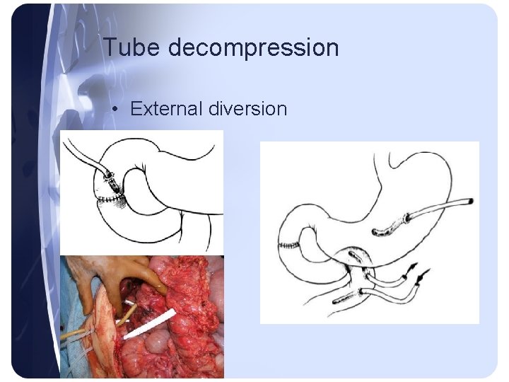 Tube decompression • External diversion Tube decompression • External diversion