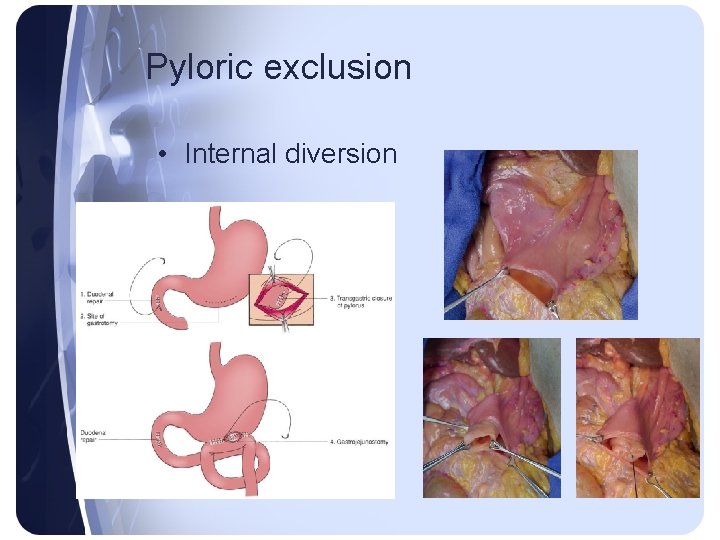 Pyloric exclusion • Internal diversion Pyloric exclusion • Internal diversion