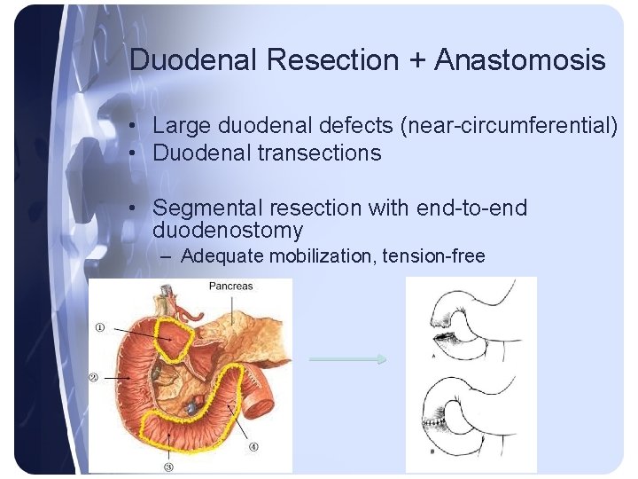 Duodenal Resection + Anastomosis • Large duodenal defects (near-circumferential) • Duodenal transections • Segmental Duodenal Resection + Anastomosis • Large duodenal defects (near-circumferential) • Duodenal transections • Segmental
