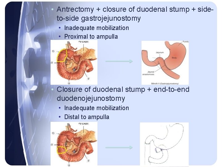 • Antrectomy + closure of duodenal stump + sideto-side gastrojejunostomy • Inadequate mobilization • Antrectomy + closure of duodenal stump + sideto-side gastrojejunostomy • Inadequate mobilization