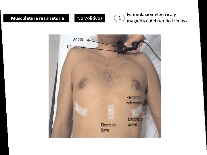 Musculatura respiratoria No Volitivos 1 Estimulación eléctrica y magnética del nervio frénico 