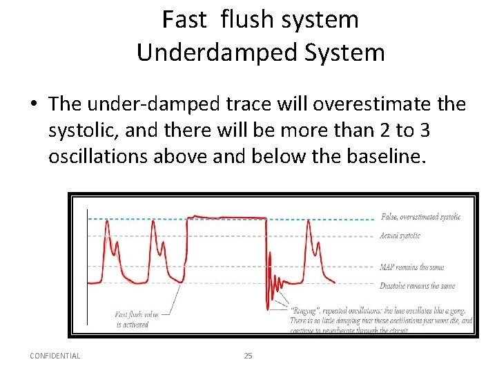Fast flush system Underdamped System • The under-damped trace will overestimate the systolic, and