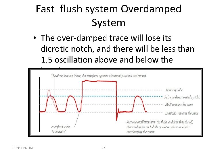 Fast flush system Overdamped System • The over-damped trace will lose its dicrotic notch,