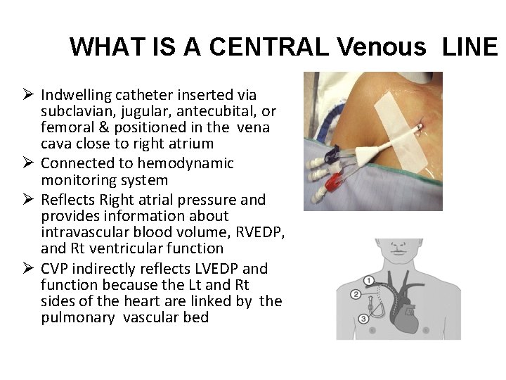 WHAT IS A CENTRAL Venous LINE Ø Indwelling catheter inserted via subclavian, jugular, antecubital,