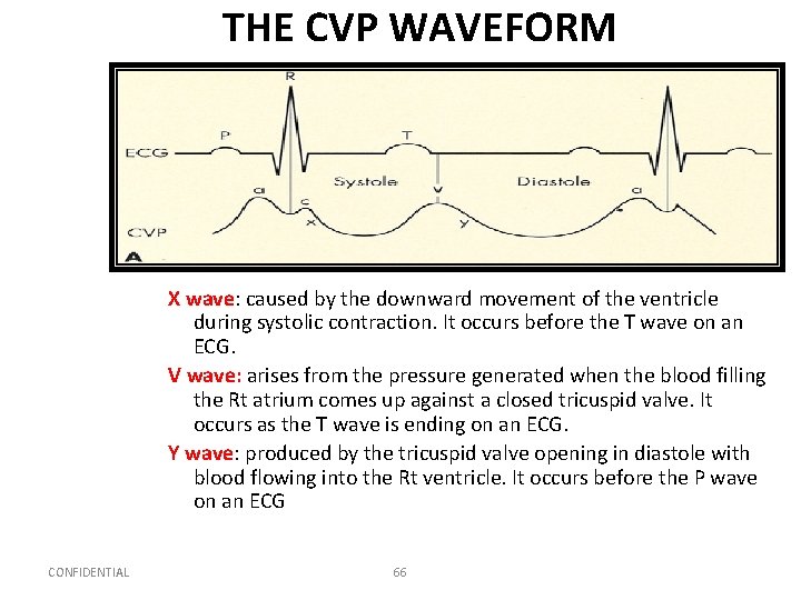 THE CVP WAVEFORM X wave: caused by the downward movement of the ventricle during