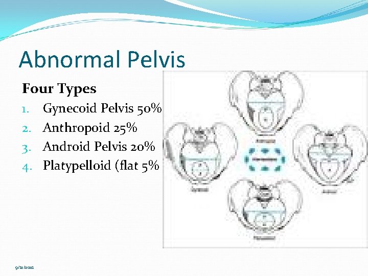 Abnormal Pelvis Four Types 1. 2. 3. 4. 9/12/2021 Gynecoid Pelvis 50% Anthropoid 25%
