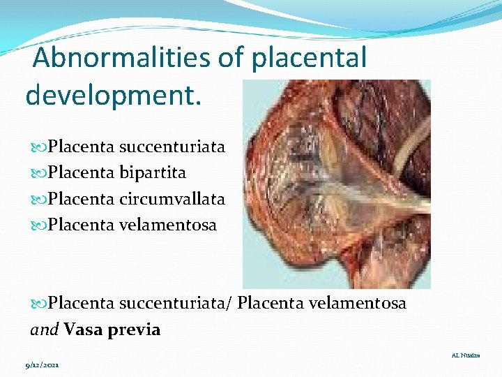 Abnormalities of placental development. Placenta succenturiata Placenta bipartita Placenta circumvallata Placenta velamentosa Placenta succenturiata/