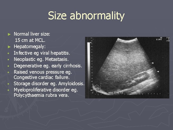 Size abnormality ► ► § § § Normal liver size: 15 cm at MCL.