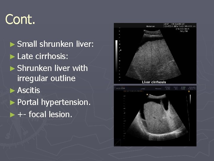 Cont. ► Small shrunken liver: ► Late cirrhosis: ► Shrunken liver with irregular outline