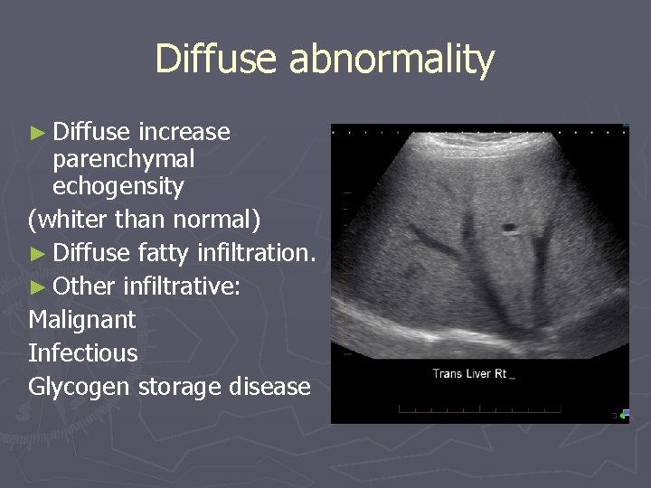 Diffuse abnormality ► Diffuse increase parenchymal echogensity (whiter than normal) ► Diffuse fatty infiltration.