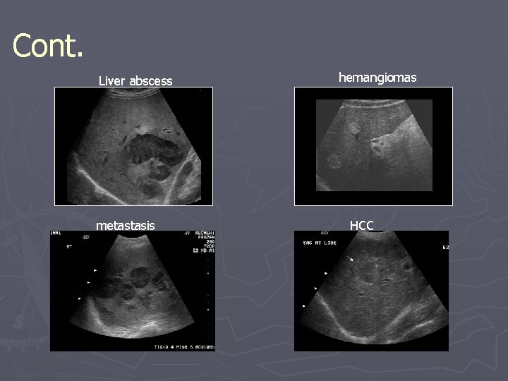 Cont. Liver abscess metastasis hemangiomas HCC 