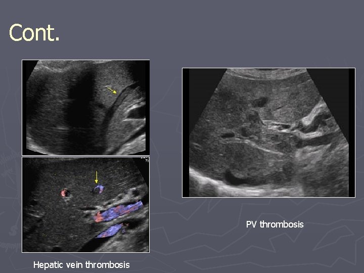 Cont. PV thrombosis Hepatic vein thrombosis 