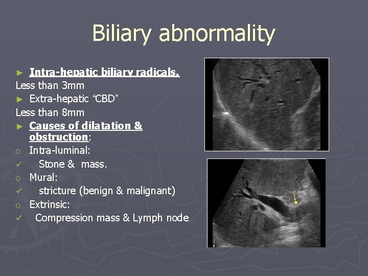 Biliary abnormality Intra-hepatic biliary radicals. Less than 3 mm ► Extra-hepatic “CBD” Less than