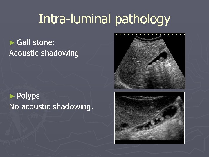 Intra-luminal pathology ► Gall stone: Acoustic shadowing ► Polyps No acoustic shadowing. 