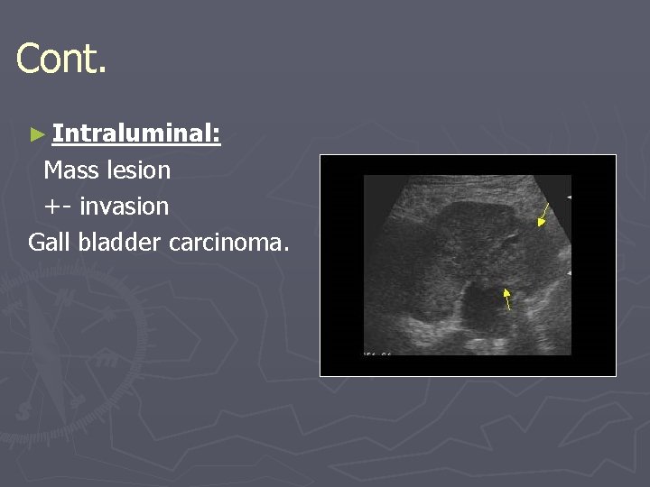 Cont. ► Intraluminal: Mass lesion +- invasion Gall bladder carcinoma. 